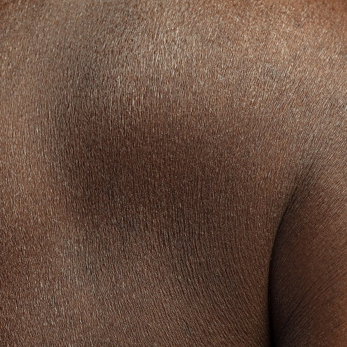 dry skin