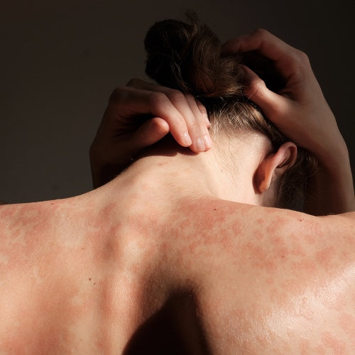 skin rash