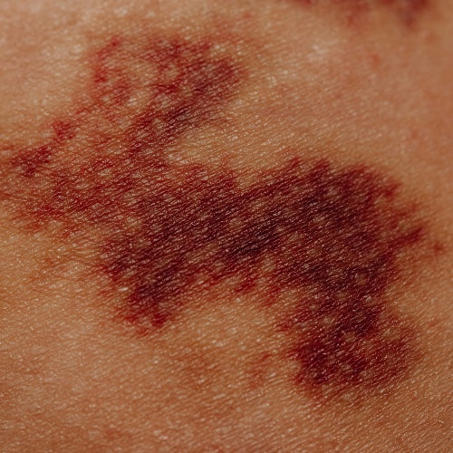 bruised skin